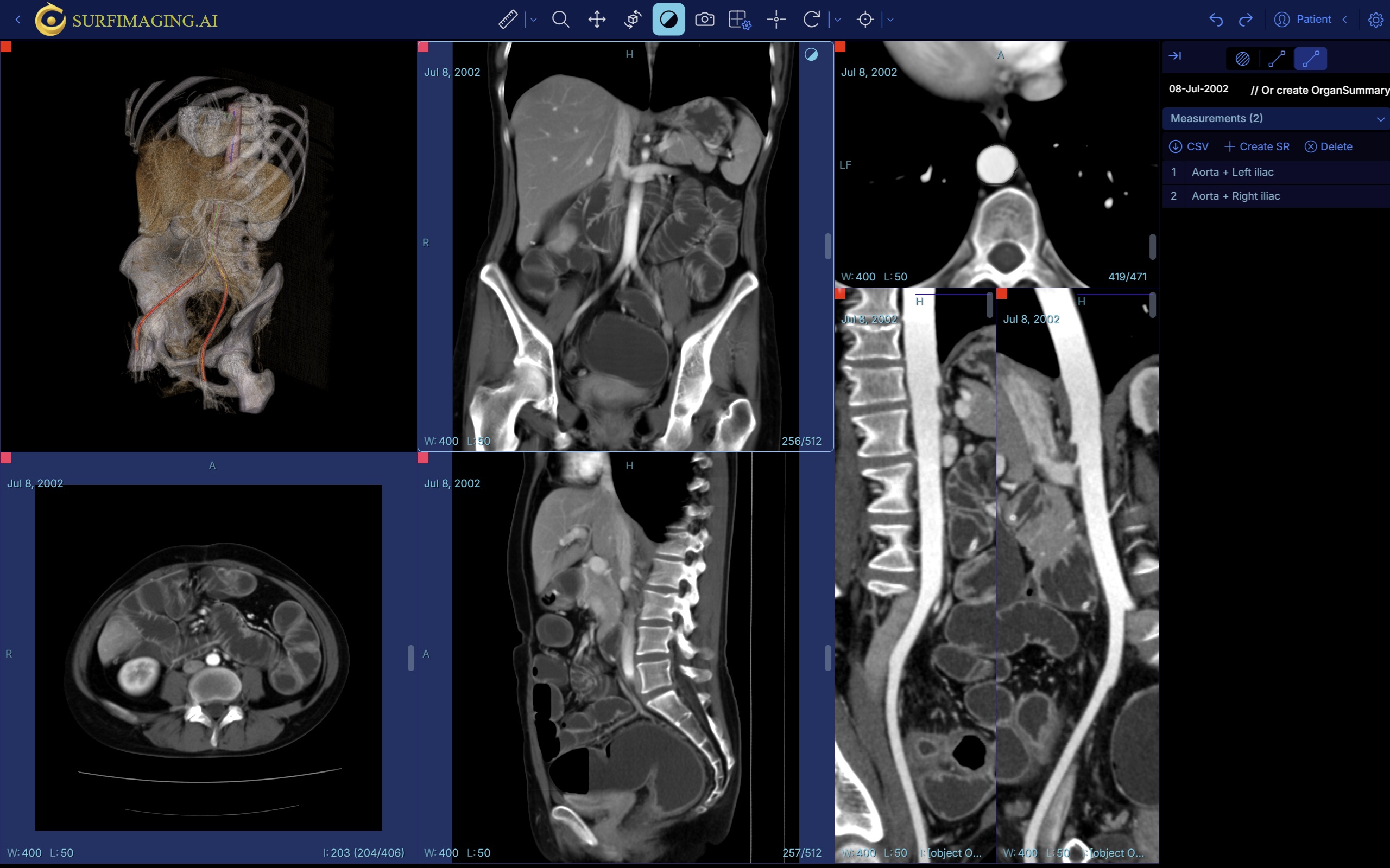 Aorta and Left Iliac