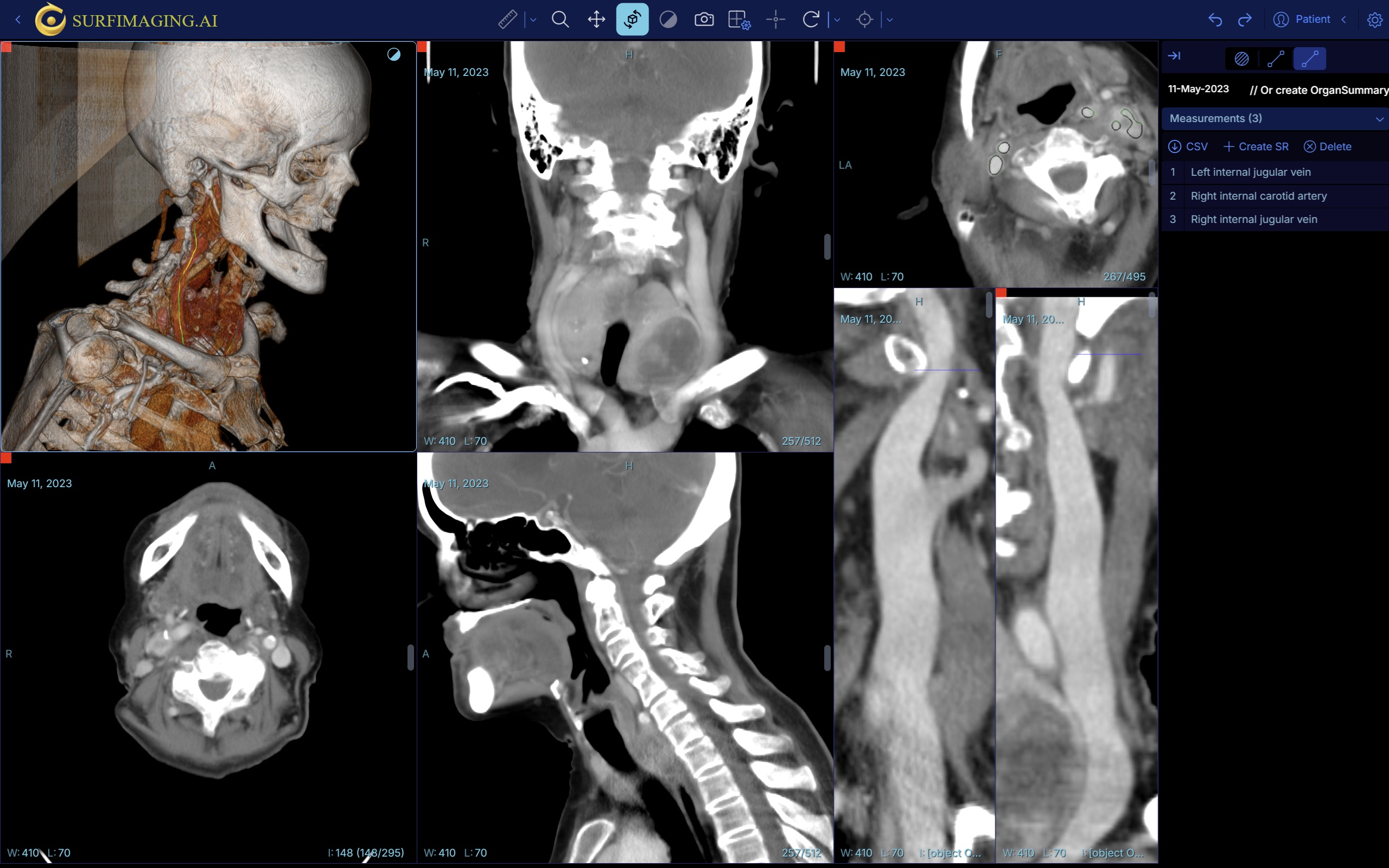 Carotid Artery and Jugular Vein