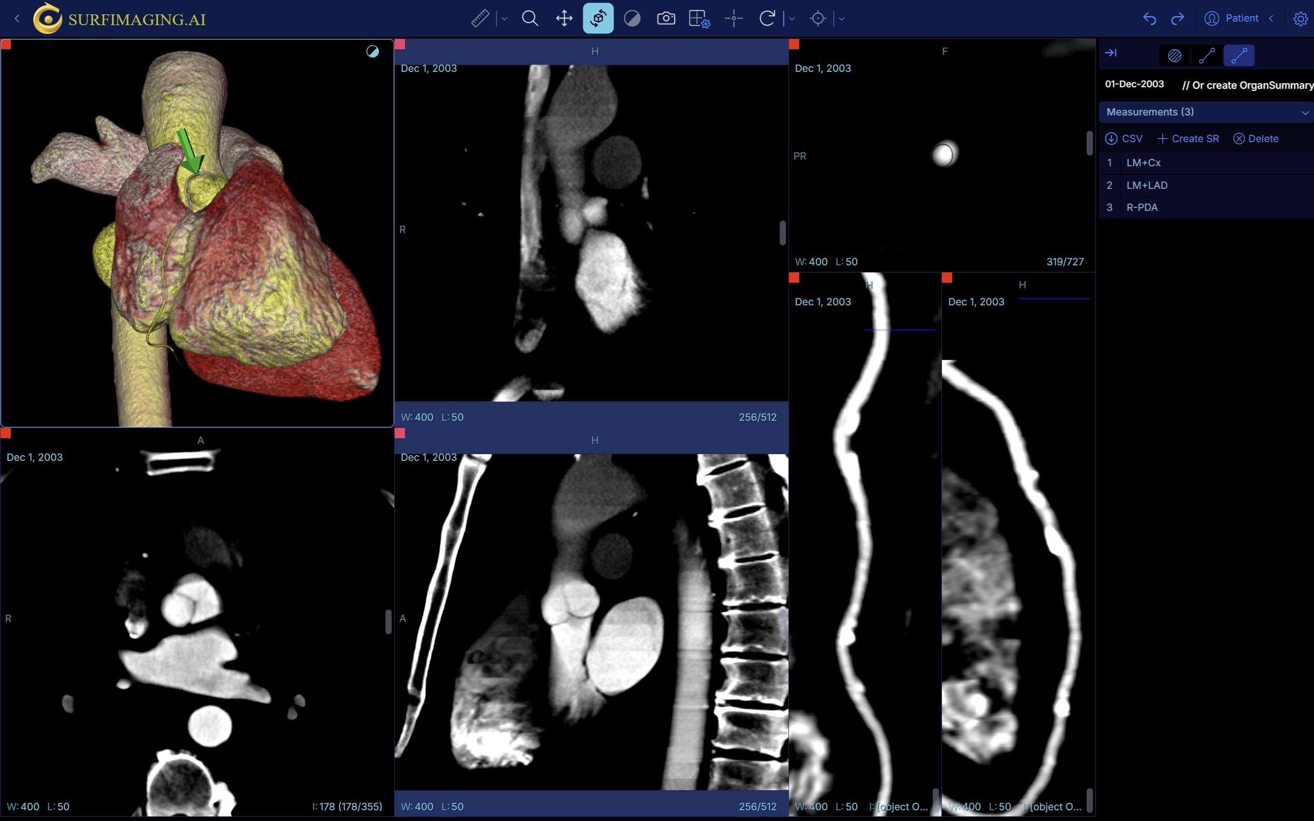 Coronary R-PDA