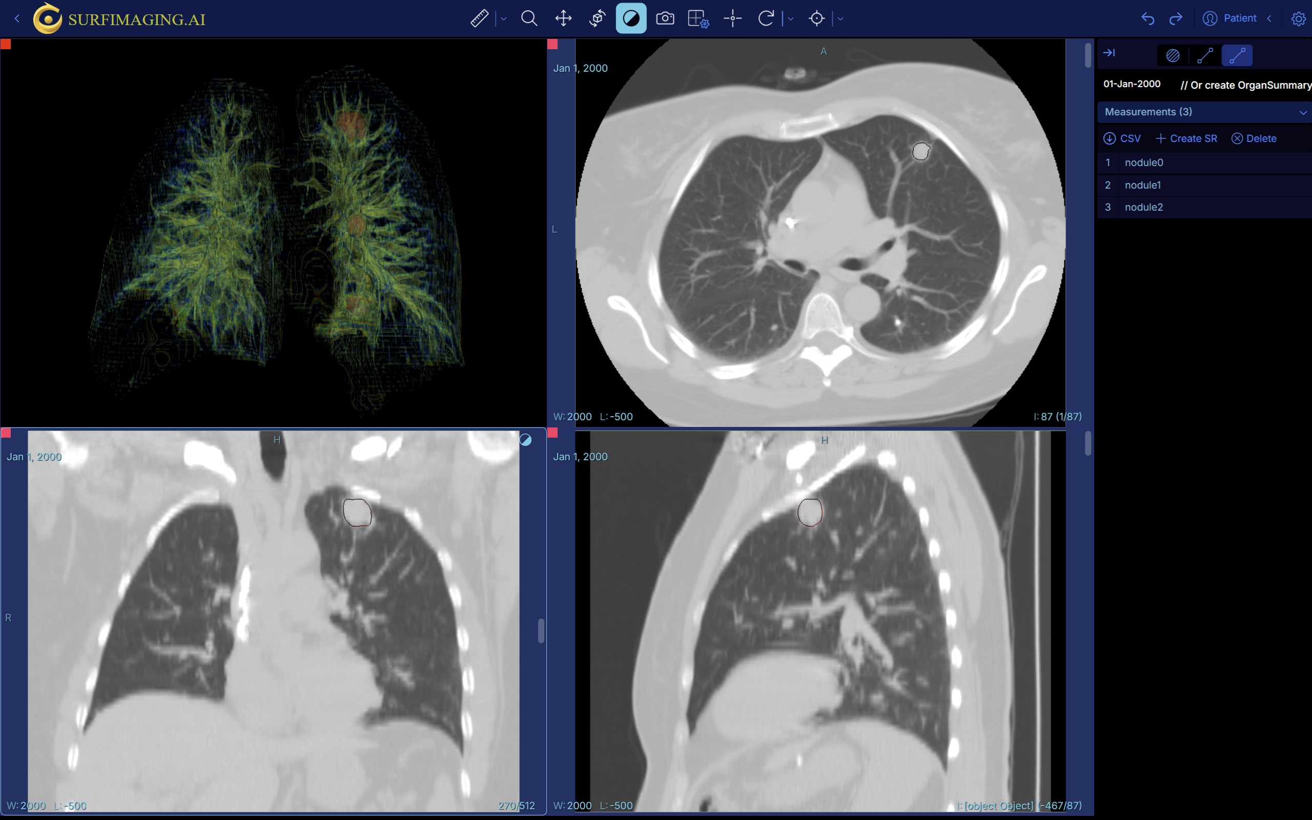 Lung Nodules