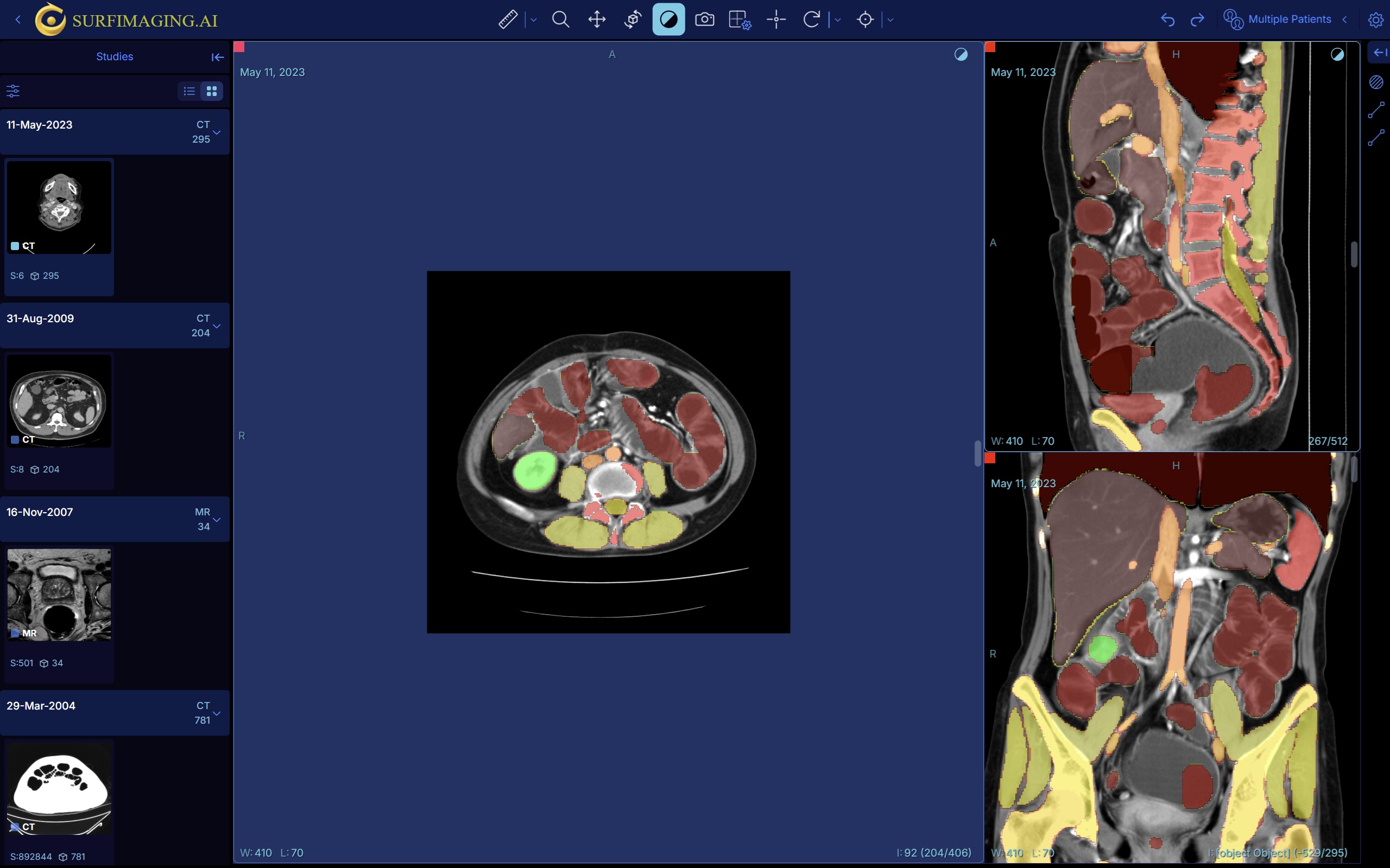 Total Segmentation MPR View